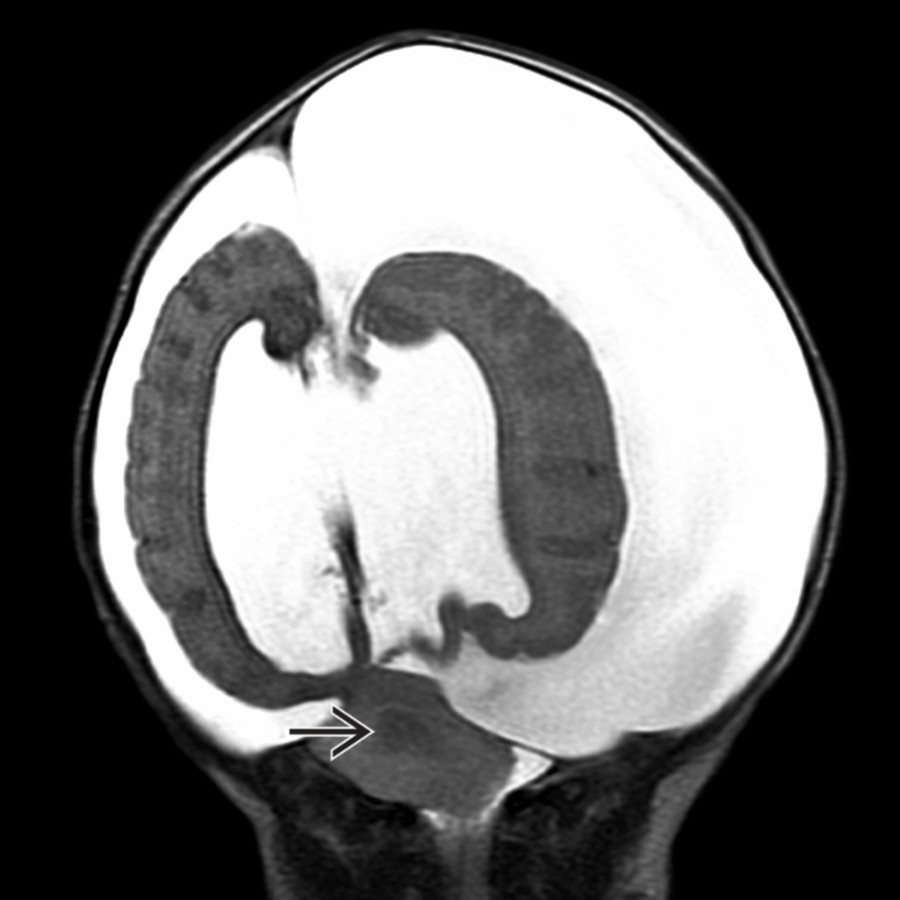Coronal T2WI MR of the same neonate, on the 1st day of life, shows marked ventriculomegaly with asymmetric bilateral subdural hygromas following spontaneous ventricular decompression into the bilateral subdural spaces. This patient also has the additional midline congenital anomaly of rhombencephalosynapsis with characteristic incomplete dentate gyrus separation
correlating with clinical truncal ataxia.
