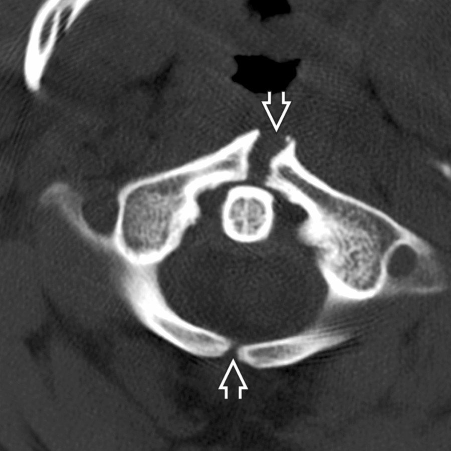 Axial bone CT shows anterior and posterior clefts
of C1. Smooth, corticated margins are signs distinguishing this from trauma.
