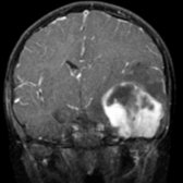 Coronal T1 C+ MR shows a heterogeneous, large, enhancing mass in the temporal lobe
. This was a ganglioglioma at resection. The temporal lobe is a common location for this tumor when there is seizure presentation.