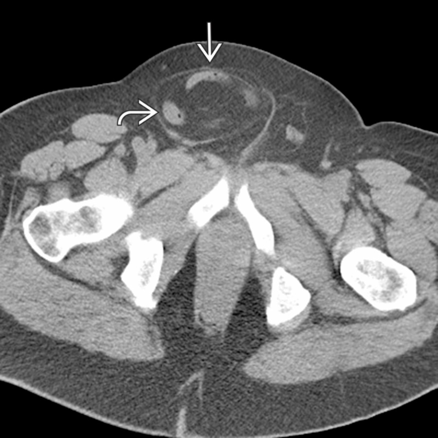 Axial CECT in a patient with a palpable groin mass demonstrates a right inguinal hernia
containing loops of small bowel
.