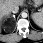 Axial CECT shows a heterogeneous, predominantly fatty right adrenal mass with calcified foci.