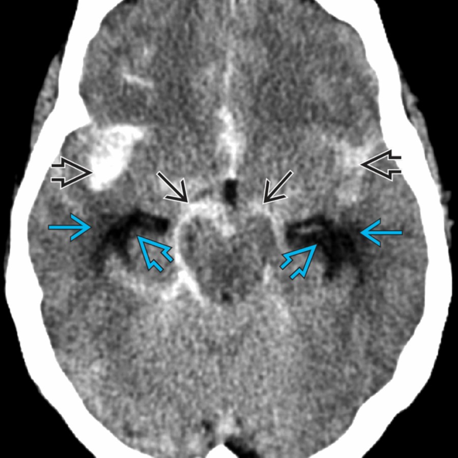 Axial NECT shows hyperdense material in the basal cisterns
and sylvian fissures
in acute subarachnoid hemorrhage. There is early dilatation of the ventricles
with mild periventricular edema
due to interstitial edema.