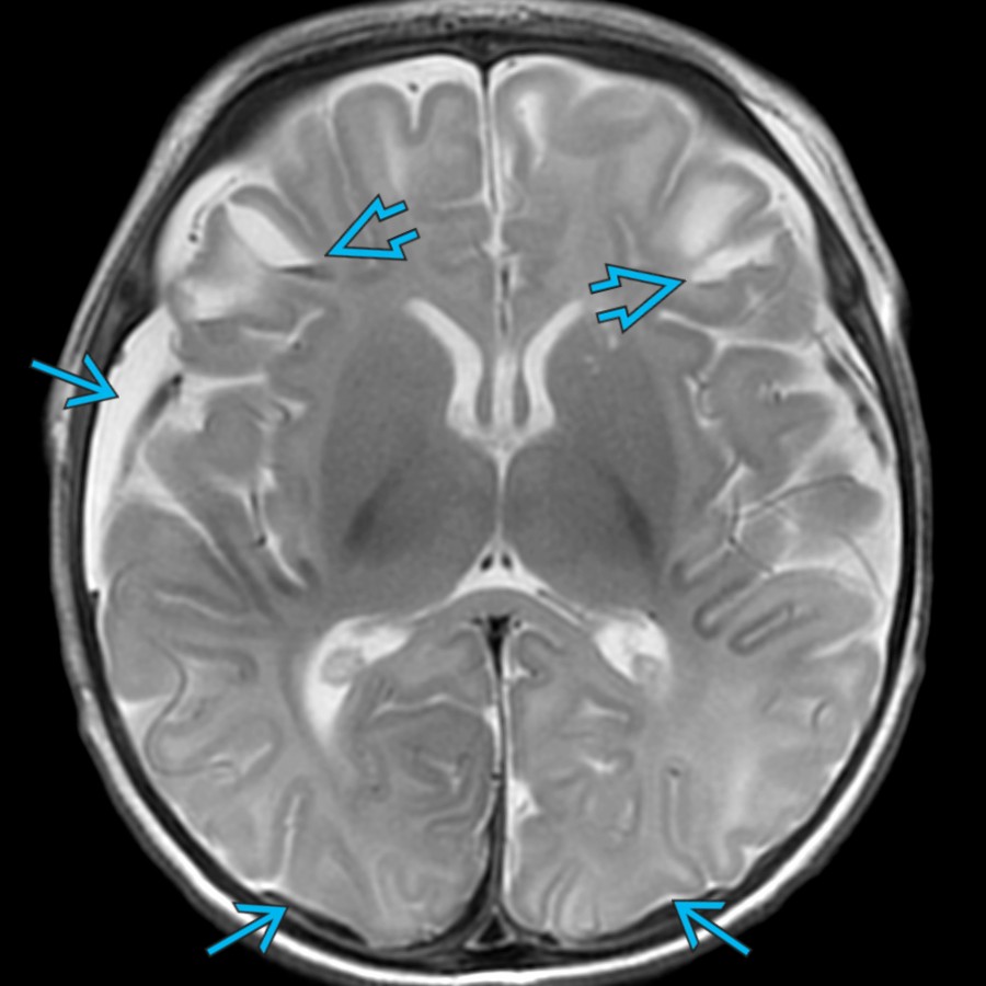 Axial T2 MR in the same patient shows bilateral clefts with hematocrit levels, consistent with lacerations
. Also note the bilateral subdural hemorrhages
. This constellation of parenchymal injury, brain lacerations, & bilateral subdural hemorrhages is highly suspicious for abusive head trauma (AHT).