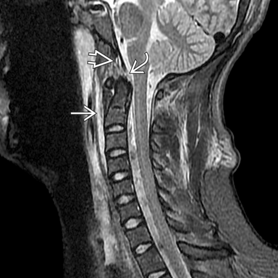 Sagittal STIR MR shows diffuse prevertebral high signal from edema
and a widened basion-dental interval
. Note the disruption of the tectorial membrane
.