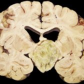 Gross pathologic specimen shows a typical solid and cystic composition
of an adamantinomatous craniopharyngioma. The cystic spaces contain a thick gelatinous material. (Courtesy AFIP.)