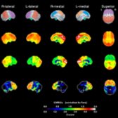 F-18 FDG PET shows reference maps (1st row), healthy older person map of glucose metabolism (2nd row), and patient's glucose metabolism (3rd row), which demonstrates strikingly diminished metabolism in the frontal and temporal lobes. Z-score map (4th row) illustrates areas of hypometabolism (compared to normal controls) in the frontal
and temporal lobe
. (Courtesy University of Utah Medical Center.)