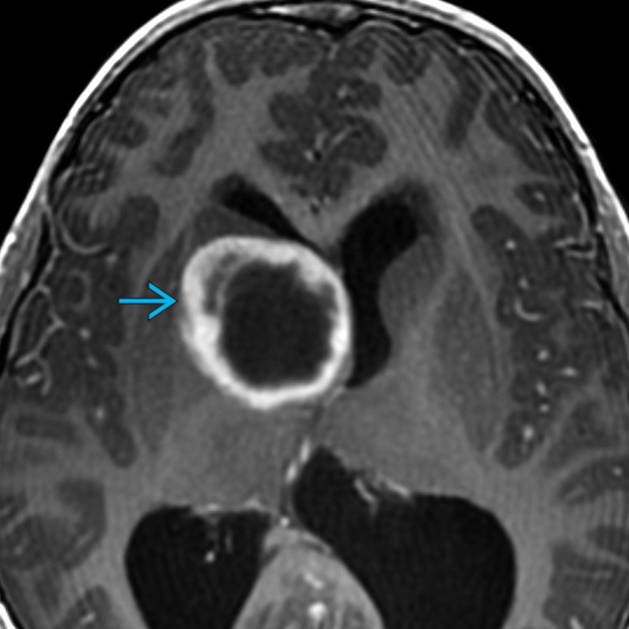 Axial T1 C+ MR in 9-year-old shows a rim-enhancing mass
with lack of adjacent edema. Enhancement patterns of PMAs vary greatly from solid homogeneous enhancement to peripheral enhancement, as seen here. Some degree of enhancement is almost universally present.