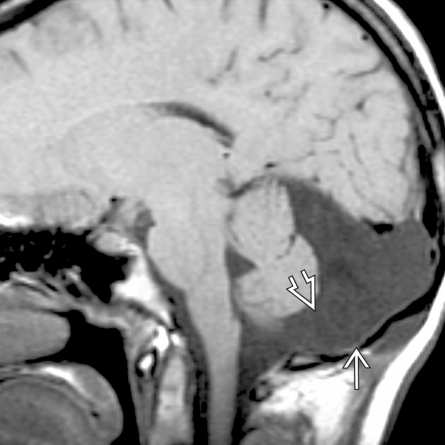 Sagittal T1WI MR demonstrates a CSF-intensity arachnoid cyst remodeling the endosteum
and filling the cisterna magna
.