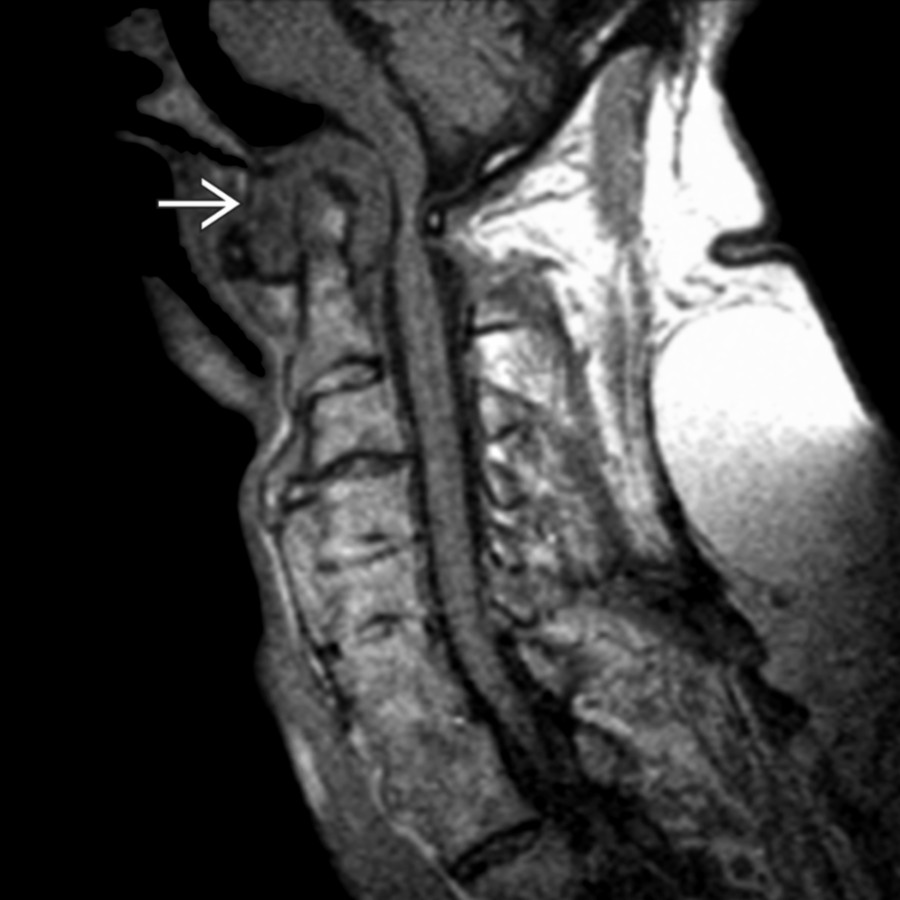 Sagittal T1WI MR shows C1-C2 degenerative pseudopannus
in a patient with diffuse idiopathic skeletal hyperostosis. The odontoid is not eroded, but the atlantodental interval is increased. Cord compression occurs between the degenerative pannus and posterior C1.