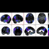 Surface projection in the same patient shows focal hypometabolism within the L > R precuneus and parietal lobes
as well as L > R frontal and temporal lobes
, most consistent with early-onset dysexecutive Alzheimer disease (AD), rather than FTD.