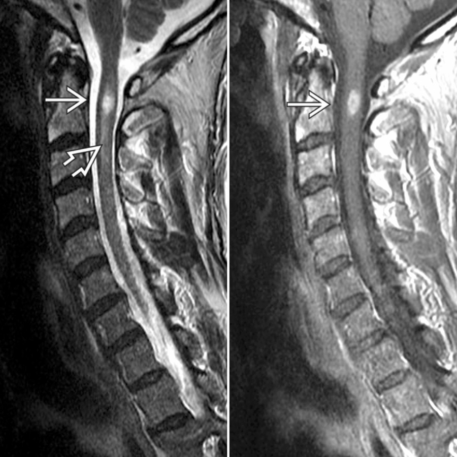 Sagittal T2 (left) & T1 C+ MR (right) show active enhancing plaque at the C2 level with both focal well-defined (enhancing) T2 focus
& a small amount of surrounding nonenhancing edema
.
