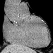 Coronal oblique NECT of ischemic heart failure shows LV enlargement with subepicardial fat
, predominantly in an LAD distribution, representing prior infract.