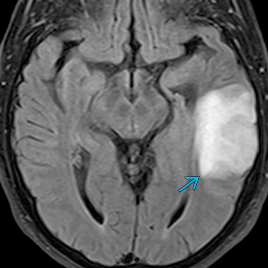 Axial FLAIR MR in a 71 year old with altered mental status shows abnormal hyperintensity in the left temporal lobe
. Differential considerations include infectious, inflammatory, and neoplastic etiologies. GAD65 AE was diagnosed at brain biopsy.