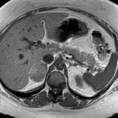 Axial T1 MR for follow-up in the same patient shows a relatively intense right adrenal lesion
. No significant signal loss was shown on out-phase imaging (not shown).