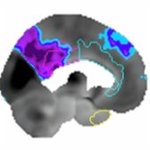 Left sagittal F-18 FDG PET quantitative analysis in the same patient shows hypometabolism in the precuneus
and posterior cingulate gyrus
. Note the pattern of AD is posterior-predominate hypometabolism.
