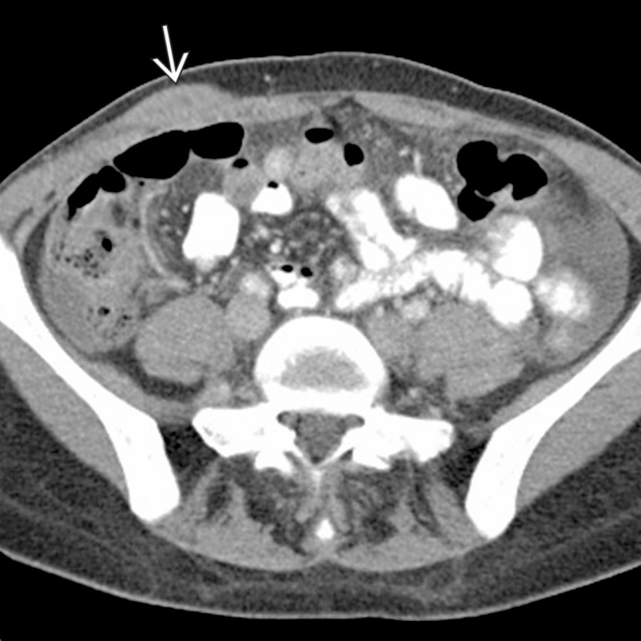 Axial CECT shows a biopsy-proven chloroma
in the right anterior abdominal wall in a patient with known leukemia.