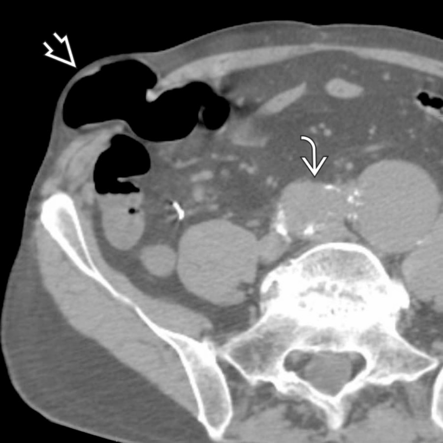 Axial NECT in a patient being imaged for iliac aneurysms
demonstrates an incidental spigelian hernia. The hernia
contains a segment of ascending colon, but there is no sign of bowel obstruction.