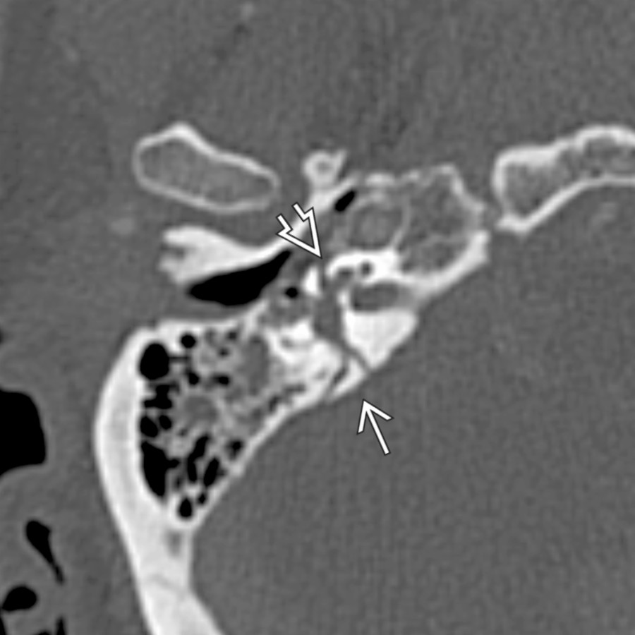 Axial bone CT shows a complex, transversely oriented T-bone fracture
that involves the otic capsule and disrupts the cochlea
. The mastoid air cells and middle ear are opacified with blood, corresponding with hemotympanum on otoscopy.