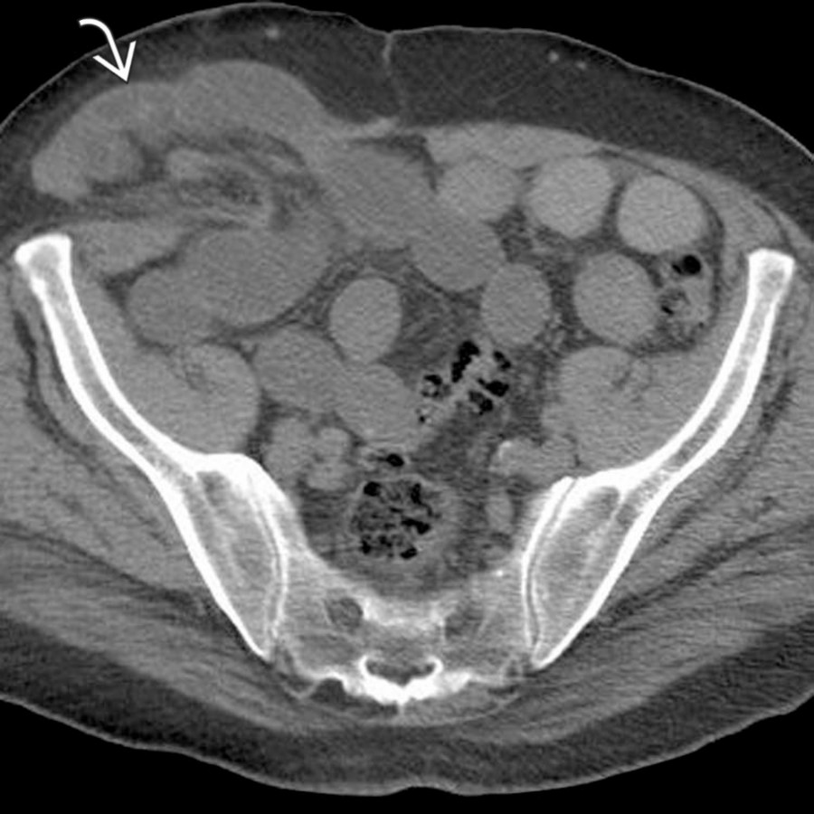 Axial CECT demonstrates a Spigelian hernia
arising just lateral to the rectus muscle. A segment of small bowel herniates through the defect, resulting in partial obstruction. The hernia and obstruction were confirmed and corrected at surgery.