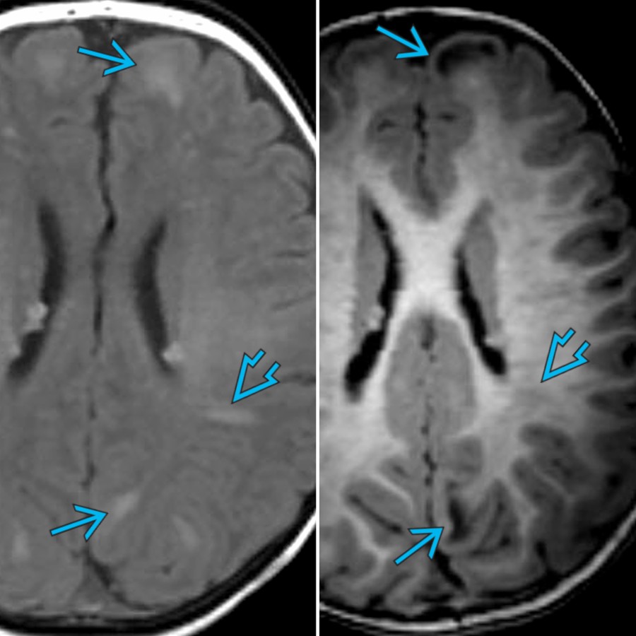 Axial T1 MR in a female infant with TSC at 3 months (left) & 10 months (right) of age shows how the cerebral tubers
& radial migration lines
are relatively hyperintense before myelination (left) & relatively hypointense after myelination (right).