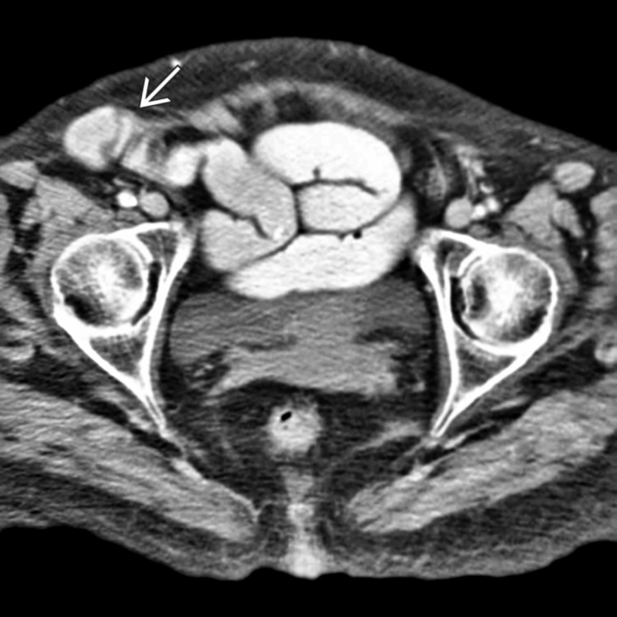 Axial CECT shows a hernia sac
lying anterior to the right femoral vessels. A contrast-opacified small bowel is present within the hernia, but no sign of bowel obstruction is seen.