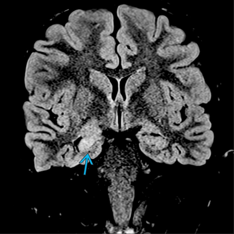 Coronal FLAIR MR shows increased T2 signal and relative volume loss of the right hippocampal formation
, consistent with mesial temporal sclerosis in this patient with temporal lobe seizures.