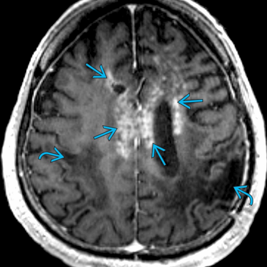 Axial T1 C+ 3D SPGR MR demonstrates a large, enhancing lesion involving bifrontal periventricular WM and corpus callosum
. Biopsy revealed demyelination. There is encephalomalacia in the bilateral parietal lobes
.