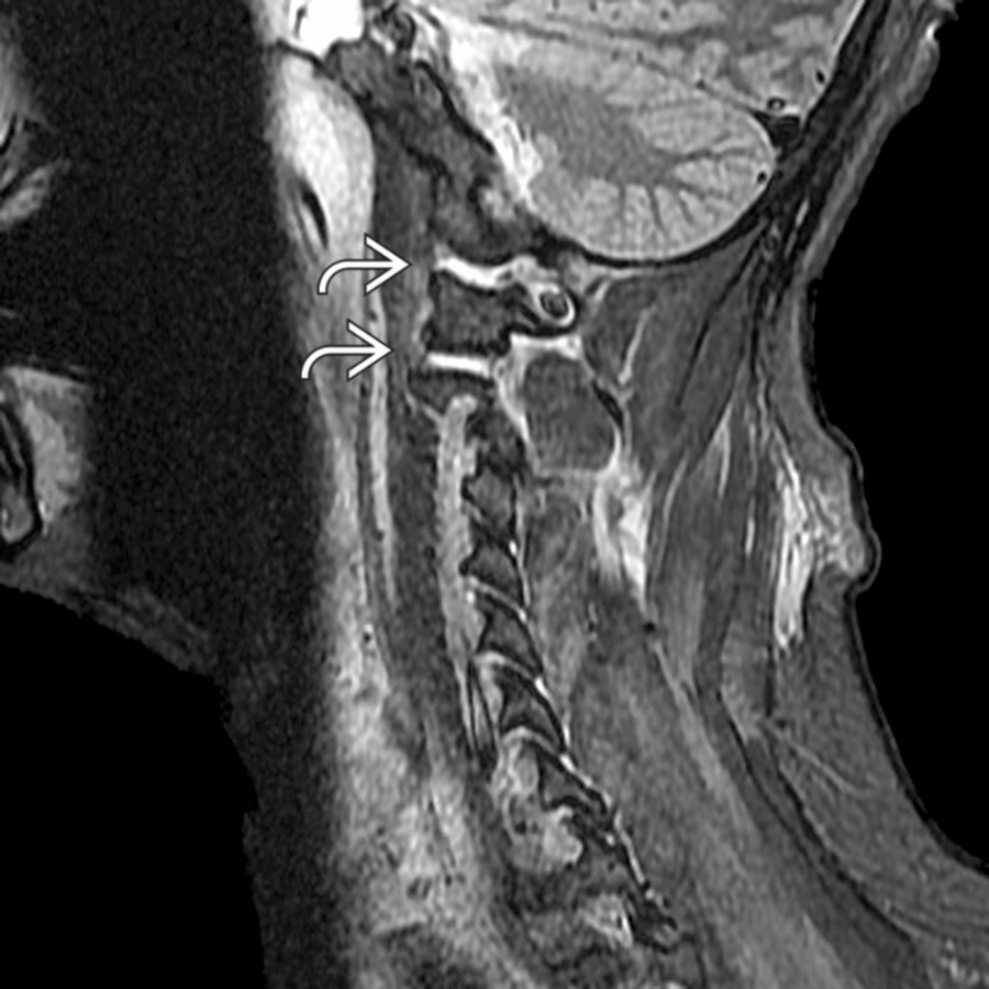 Sagittal STIR MR shows abnormal hyperintensity within the C0-C1 and C1-C2 articulations
due to simultaneous atlantooccipital and atlantoaxial subluxations. The 2-level abnormality is important to identify since the posterior fusion will be extended more inferiorly.