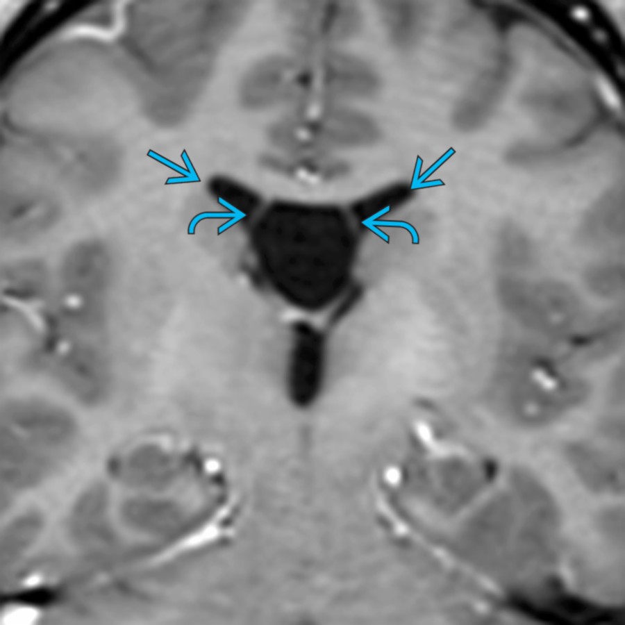 Coronal T1 C+ SPGR MR shows a classic large CSP between the frontal horns
. There is lateral bowing of the leaves of the septum pellucidum
.