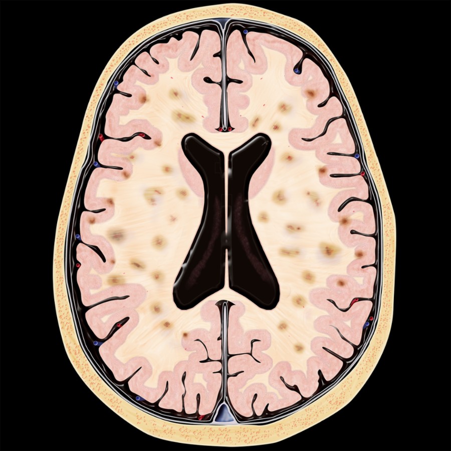 Axial graphic shows multifocal infarcts involving the cortical gray matter and subcortical white matter bilaterally.