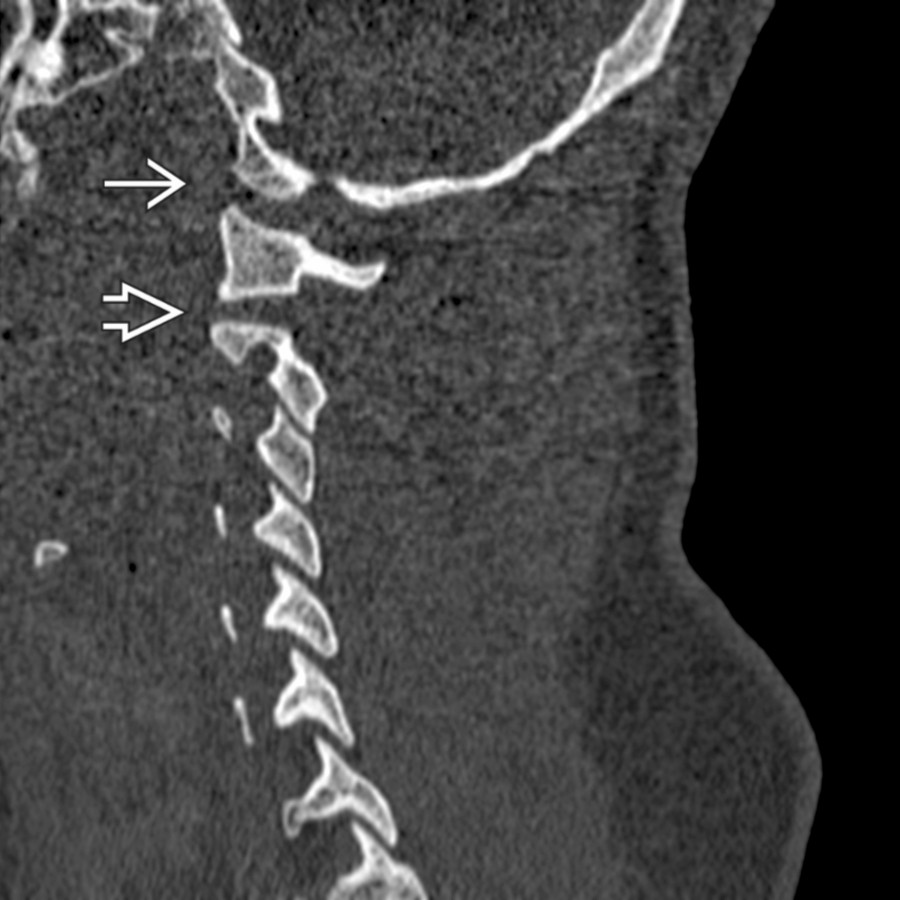 Parasagittal CT shows slight widening of both C0-C1
and C1-C2
articulations in this patient with both atlantooccipital and atlantoaxial subluxations.