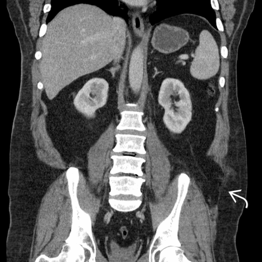 Coronal CECT shows avulsion
of the muscular and tendinous insertions of the abdominal wall muscles from the left iliac wing and thoracolumbar fascia with creation of a posttraumatic lumbar hernia. Posttraumatic lumbar hernias are rare but much more likely to be associated with strangulation or incarceration.