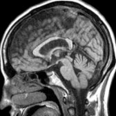 Sagittal T1WI MR shows atrophy of the posterior corpus callosum body
. DTI showed ↓ FA in the corpus callosum. Voxel-based morphometry has high sensitivity in detecting local tissue atrophy in the motor cortex and along the CSTs.