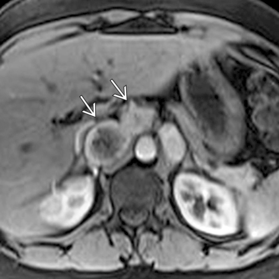 Corresponding axial T1WI C+ FS MR demonstrates the same paragangliomas
. Notice the salt and pepper appearance of the right-most paragangliomas, consisting of enhancing parenchyma and internal flow void (hypervascularity).