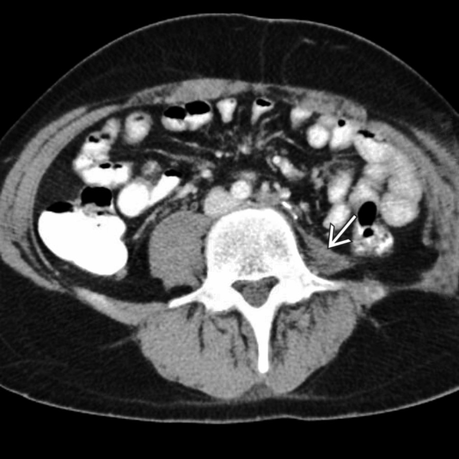 Axial CECT shows marked asymmetry of the psoas muscles. In this case, the left psoas muscle
is atrophic due to a prior left leg amputation.
