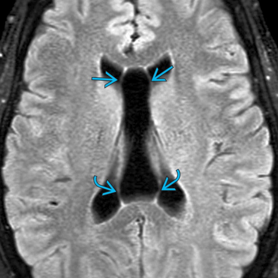 Axial FLAIR MR shows a large CSP with CV as a large CSF collection between the leaves of the septum pellucidum
continuing directly posteriorly with the CSF collection, splaying the fornices laterally
.