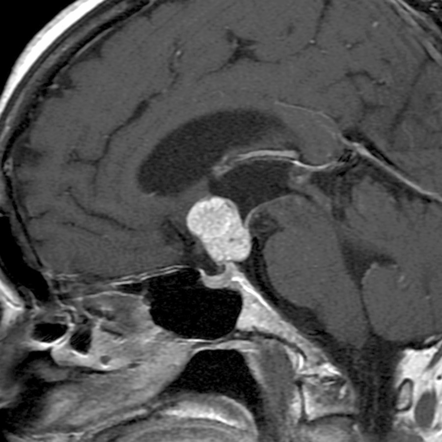 Sagittal T1 C+ FS MR shows a papillary craniopharyngioma in an adult man. Papillary craniopharyngiomas are most often solid masses.