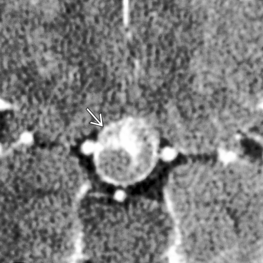 Axial CECT shows pituitary apoplexy caused by a necrotic pituitary macroadenoma
. Imaging appearance resembles a thrombosed aneurysm.
