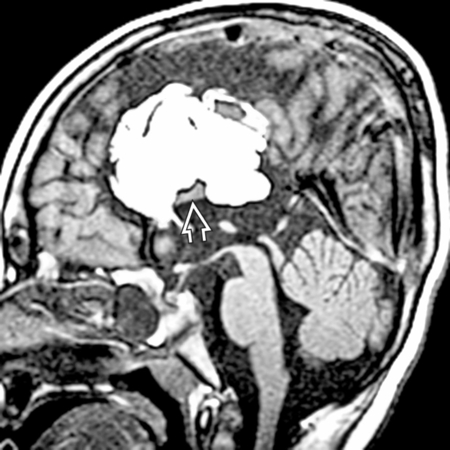 Midline sagittal T1 MR shows a large pericallosal lipoma with severe dysgenesis of the corpus callosum
.