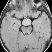 Axial FLAIR MR in a 2 year old with a tuber cinereum hamartoma shows a large suprasellar mass
that is isointense to the brain parenchyma.