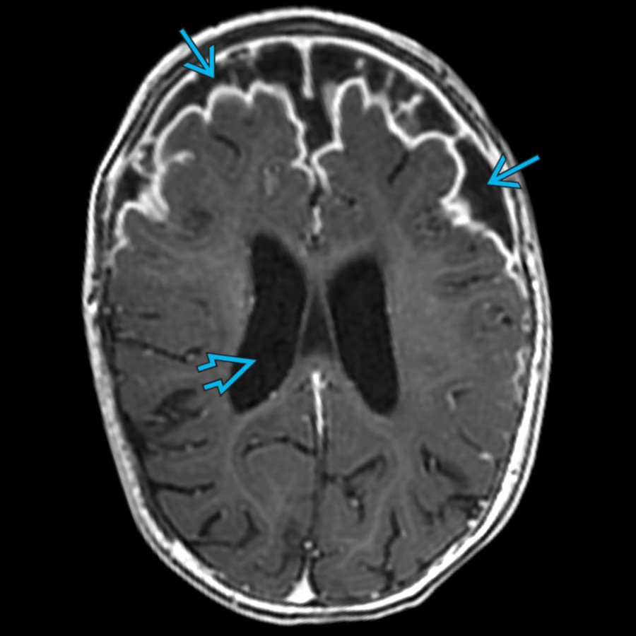 Axial T1 C+ MR in a 7-year-old with Haemophilus influenzae meningitis shows marked expansion of the bifrontal SAS
& mild enlargement of the lateral ventricles
.