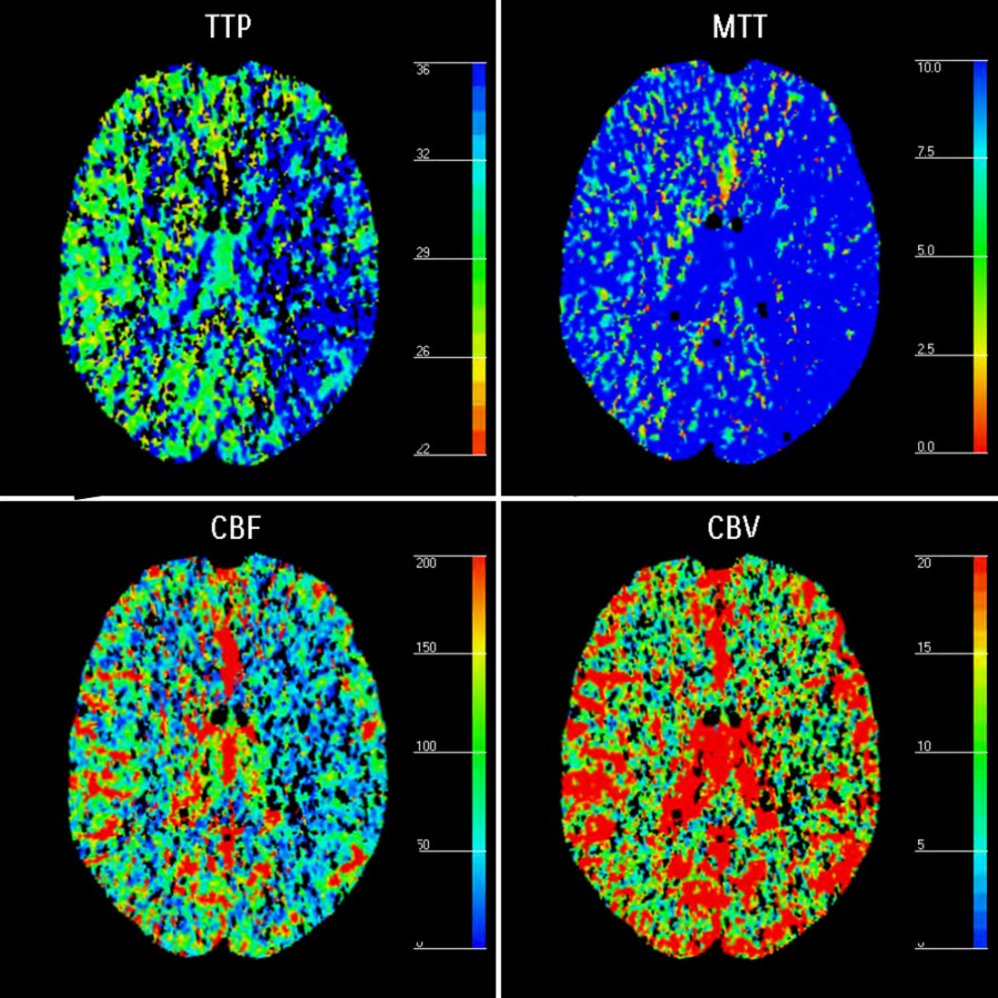 CT perfusion in the same patient demonstrates a large ischemic penumbra in the left MCA and anterior carotid artery (ACA) territory secondary to the left ICA occlusion.