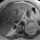 Axial in-phase T1 MR shows a mildly heterogeneous right adrenal mass
in a 62-year-old woman with hirsutism.