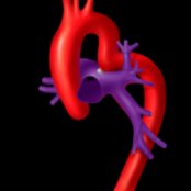 Coronal oblique graphic in a patient with pseudocoarctation of the aorta (PCOA) demonstrates an elongated, kinked, and buckled aortic arch
distal to the origin of left subclavian artery
at the level of the ductus arteriosus.