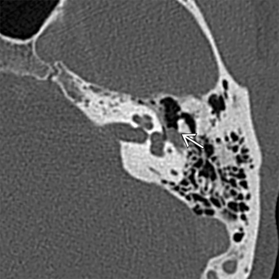 Axial bone CT in the same patient shows localized expansion of the tympanic segment of facial nerve due to schwannoma
, where tumor appears to erode the short process of incus. Tympanic segment schwannomas more often cause facial nerve paralysis &/or conductive hearing loss.