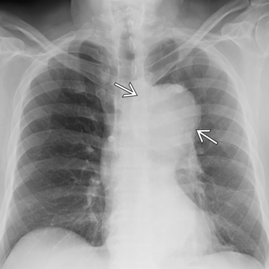 PA radiograph in a man in his '80s who presented with streptococcus pneumonia bacteremia and left shoulder pain demonstrates an enlarged aortic contour
concerning for thoracic aortic aneurysm. CTA was recommended.