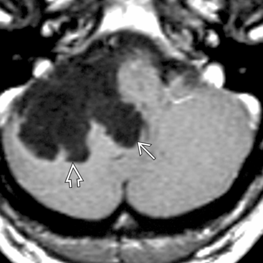 Axial T1 C+ MR reveals a low signal intensity, nonenhancing epidermoid cyst that insinuates into the foramen of Luschka
and along the right cerebellar hemisphere
. DWI MR sequence would show restricted diffusion. FLAIR would show lack of complete fluid suppression.
