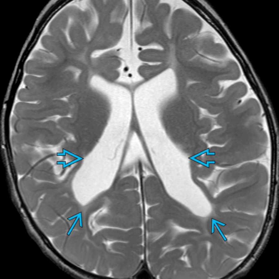 Axial T2 MR in a 5-year-old boy with spastic cerebral palsy demonstrates irregular lateral ventricles
with paucity of white matter and periventricular hyperintensities
, consistent with periventricular leukomalacia.