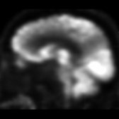 Sagittal PET in early AD shows a classic pattern of hypometabolism in the posterior cingulate gyrus and precuneus
. (Courtesy S. Nayak, MD.)