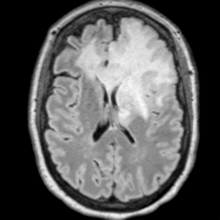 Axial FLAIR MR shows a large, T2-hyperintense mass in the left frontal lobe extending across the corpus callosum to the right frontal lobe and centrally to involve the basal ganglia. This was a 1p/19q co-deleted oligodendroglioma at biopsy. These tumors are often calcified and located in the frontal lobe.